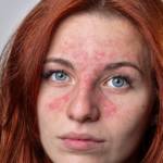 rosacea