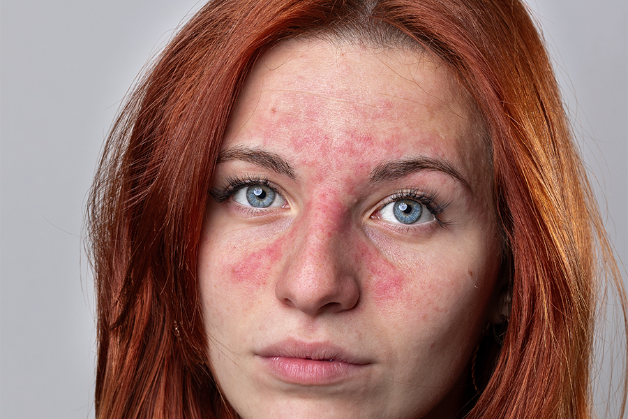 rosacea