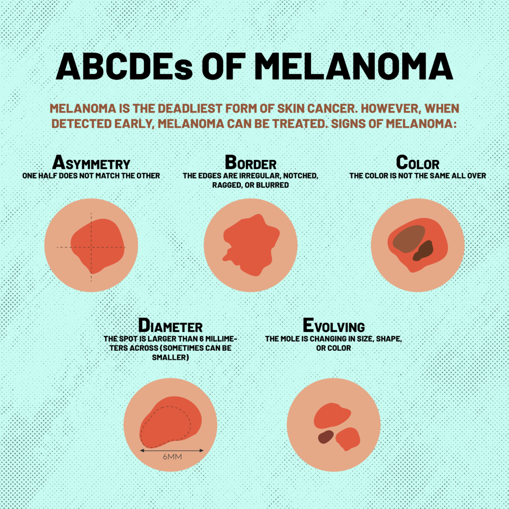 signs of melanoma